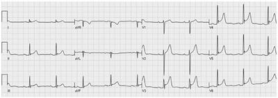 Long-Term Follow-Up of Subjects Without Overt Heart Disease With an Early Repolarization/J Wave Electrocardiographic Pattern